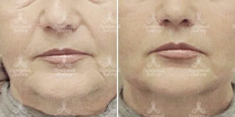Мезонити для подтяжки лица (фото)