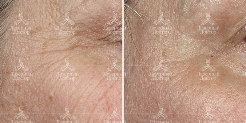 fraxel для век