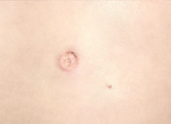 Удаление новообразований фото до и после