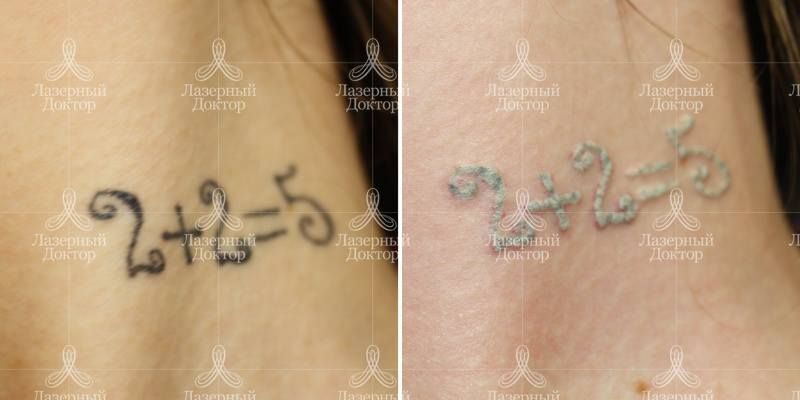 Фото до и после сведения тату лазером