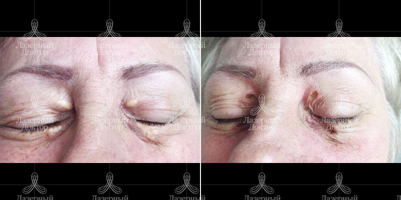 новообразования до и после