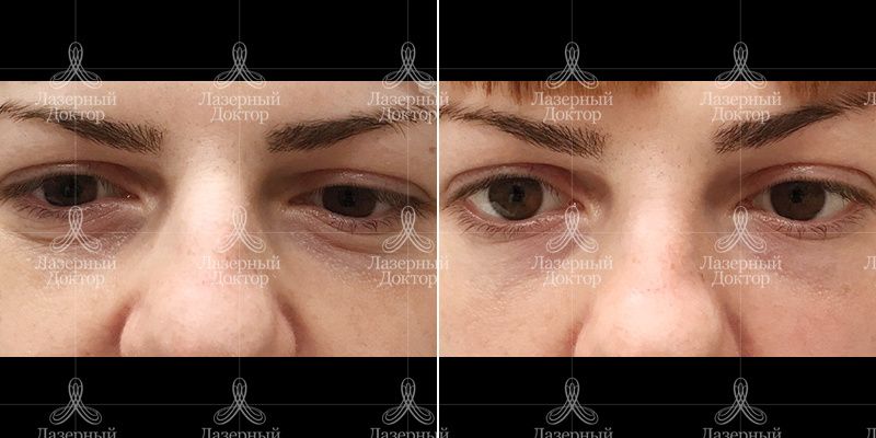 контурная пластика нос