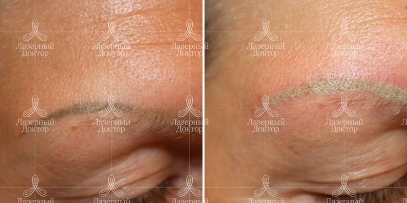 Удаление татуажа лазером: фото