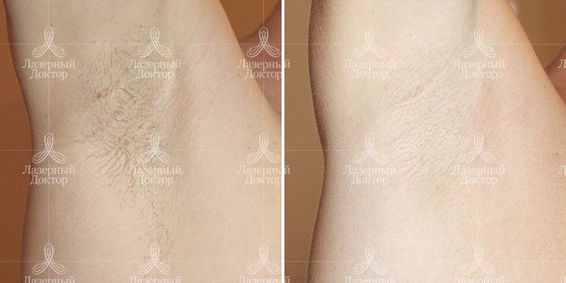 Эпиляция motus подмышечных впадин (результат на светлых волосах)