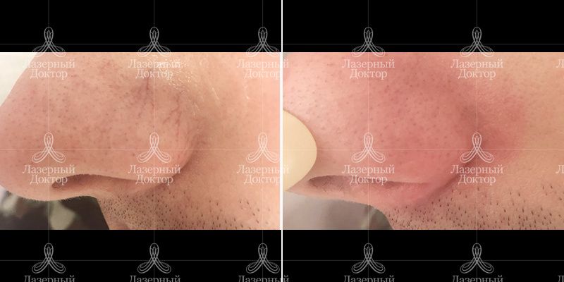 удаление сосудов