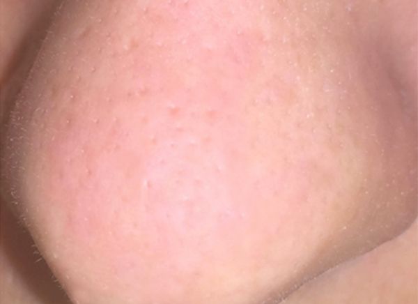 Ультразвуковая чистка лица фото до и после