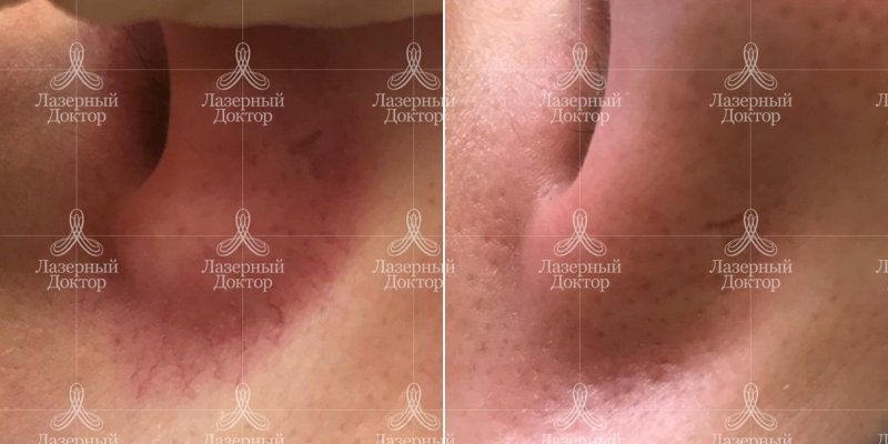 Удаление сосудов