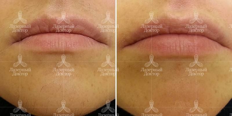Удаление нежелательных волос на лице лазером