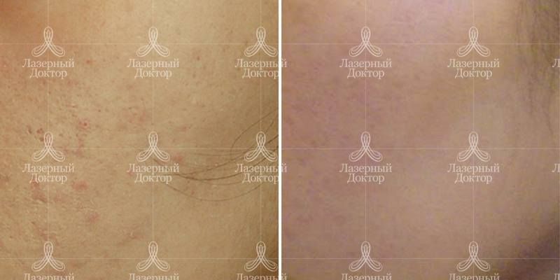 Фото лечения прыщей.