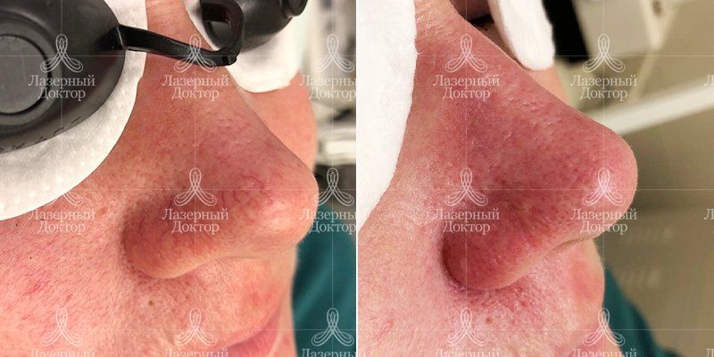 IPL-фотолечение Quantum