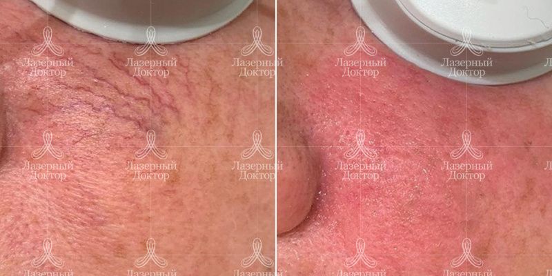 IPL фотолечение Quantum