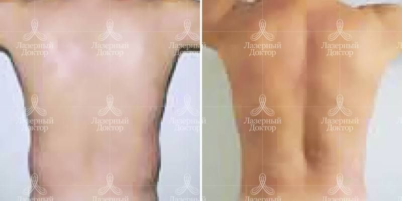 Акваликс липолитик (фото)