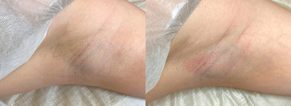 Лазерная эпиляция triple