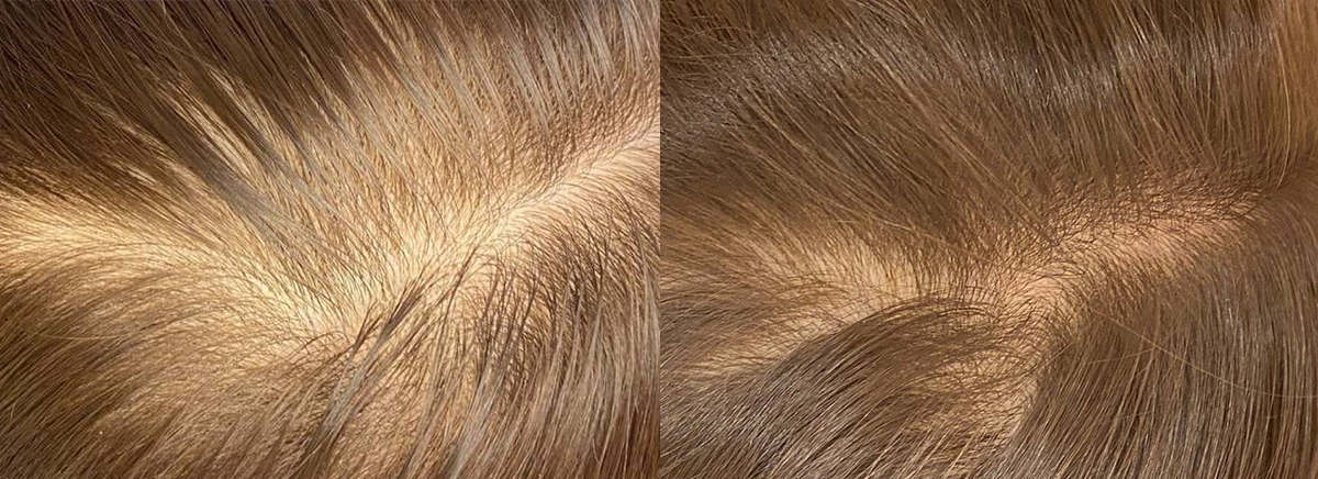 Мезотерапия волос