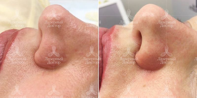 Удаление сосудов