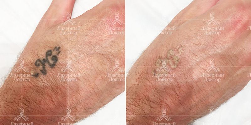 удаление татуировки на руке до и после
