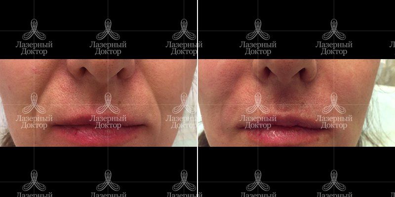 Контурная пластика носогубных складок