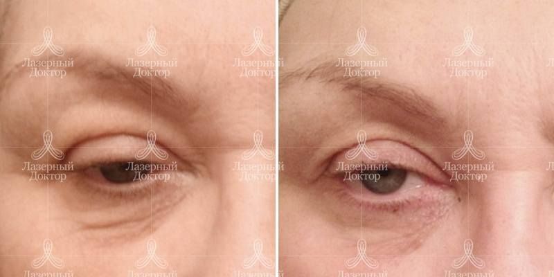 Ботулотоксин: фото до и после уколов