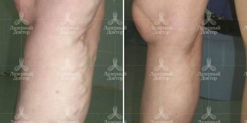 Эндовенозная лазерная облитерация вен (фото)