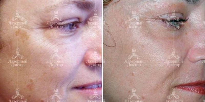 Фракционное омоложение fraxel