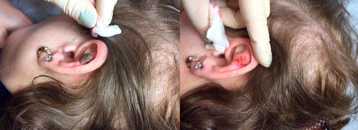 Удаление невуса