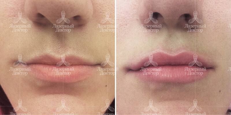 Контурная пластика губ