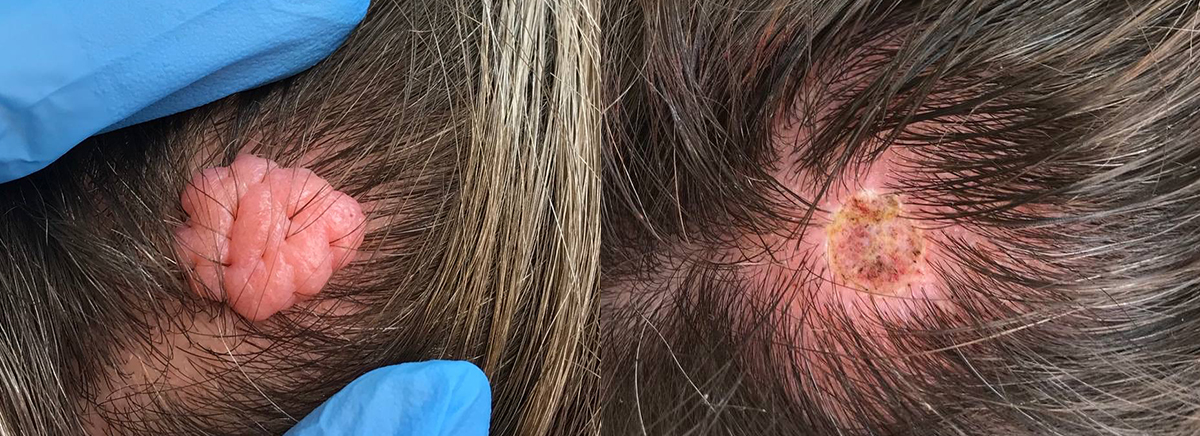 удаление новообразования