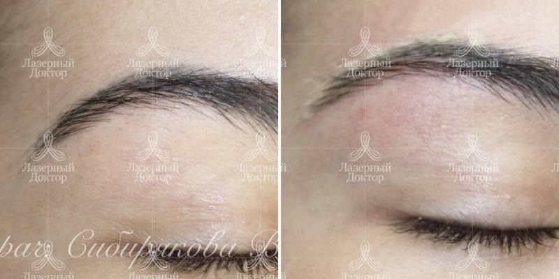 Лазерное удаление татуажа бровей: фото