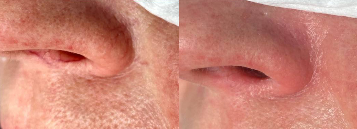 Удаление сосудов на аппарате ктп