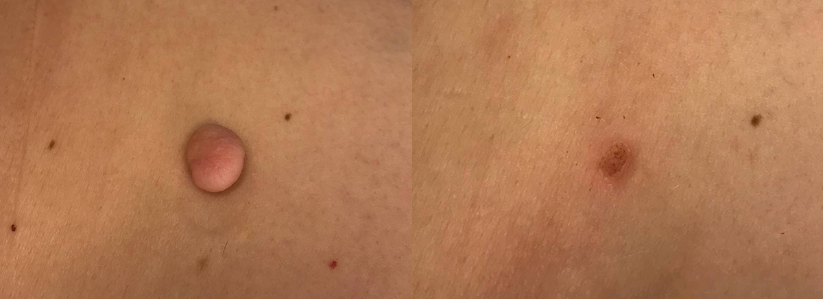 удаление новообразования