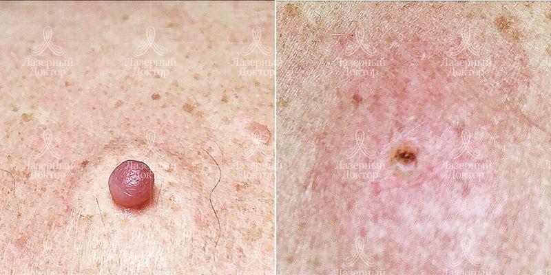 Новообразования до и после