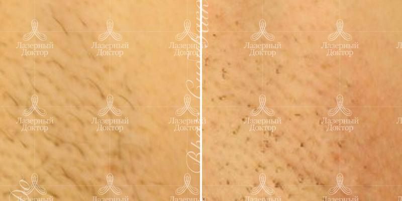 Подмышки после лазерной эпиляции (фото)