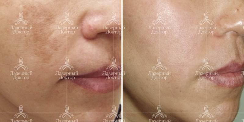 Лазерное удаление пигментных пятен (фото)