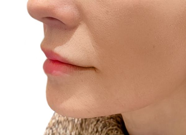 SMAS-лифтинг ULTRAFORMER фото после