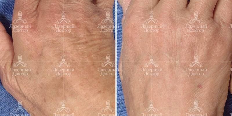 Фракционный фототермолиз (фото до после)