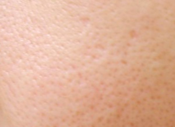 Карбоновый пилинг лица фото до и после