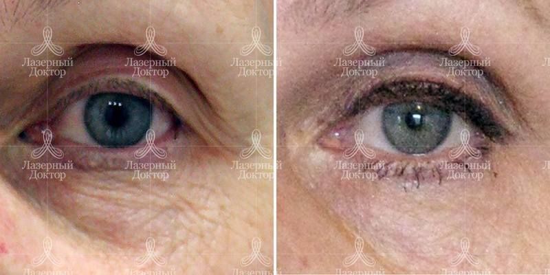 ЗD-волюмизация век и зоны вокруг глаз