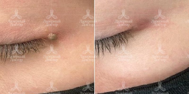 удаление новообразований