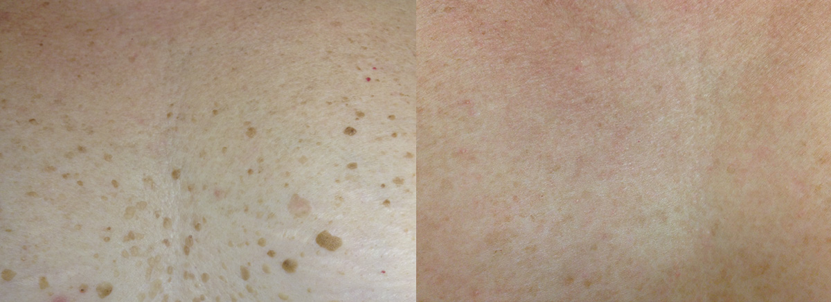 лечение кератомы на груди