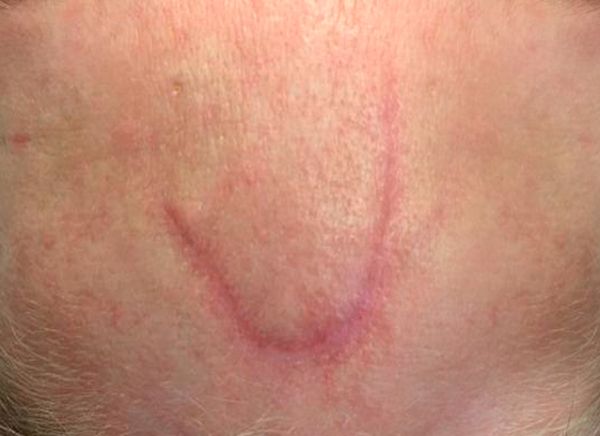 Лазерное удаление шрамов