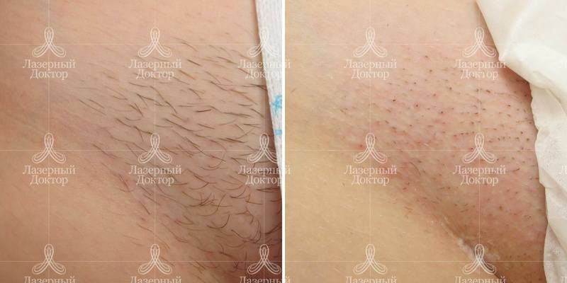 Лазерная эпиляция бикини: фото до и после