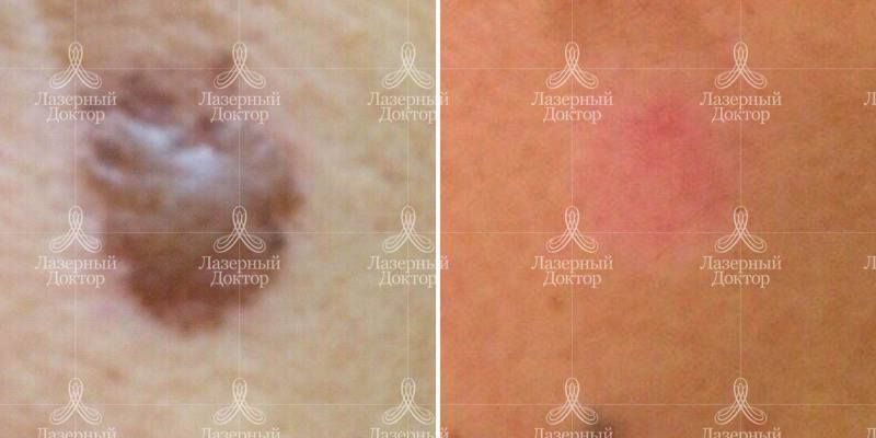 удаление родинки лазером (фото)