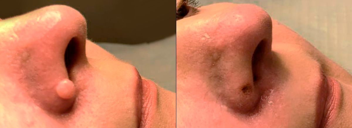 Удаление новообразований на лице