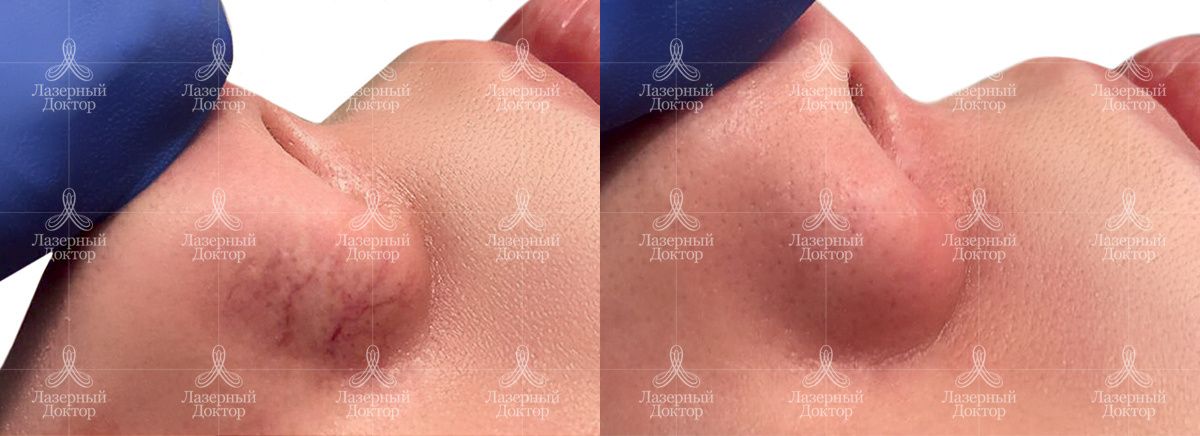 Удаление сосудов фото до и после