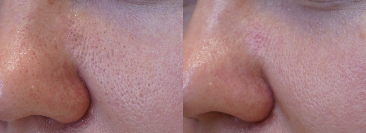 Ультразвуковая чистка лица