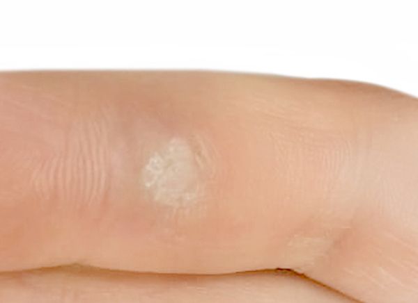 Удаление новообразований фото до и после