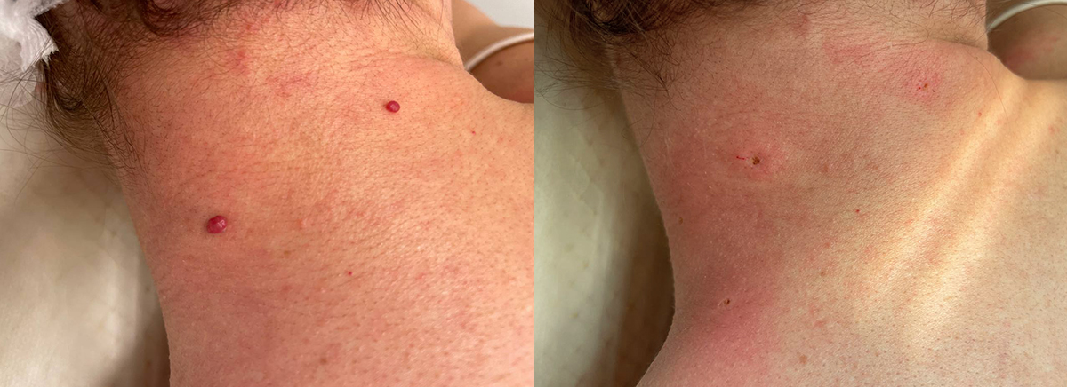 удаление ангиомы