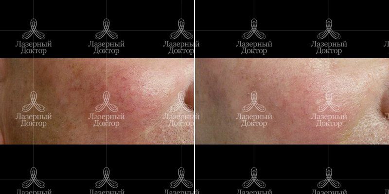 Удаление сосудов