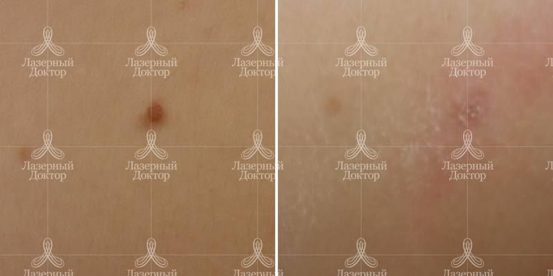 Лазерное удаление невуса на спине