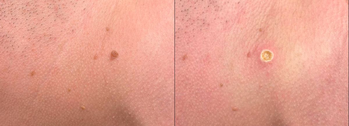 Удаление новообразования